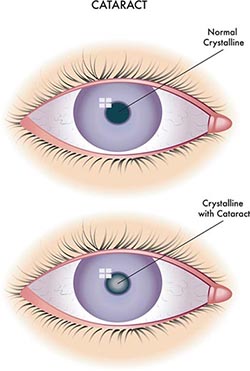 Cataracts