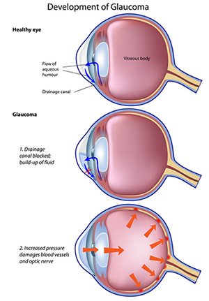 Development of Glaucoma
